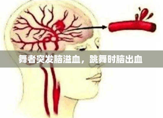 舞者突发脑溢血，跳舞时脑出血 